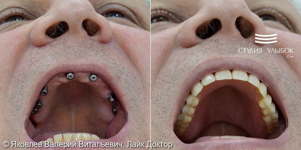 Результат тотального протезирования у пациента с полным отсутствием зубов на верхней челюсти - фото №2