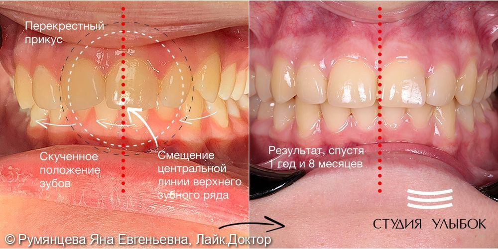 Лечение перекрестного прикуса, смещения верхнего зубного ряда, несовпадения центральной линии, скученного положение зубов - фото №1