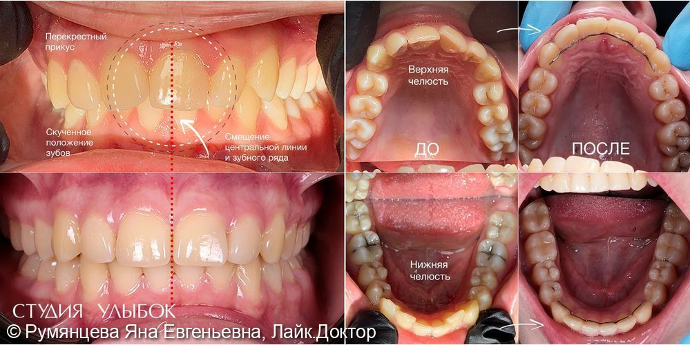 Лечение перекрестного прикуса, смещения верхнего зубного ряда, несовпадения центральной линии, скученного положение зубов - фото №3