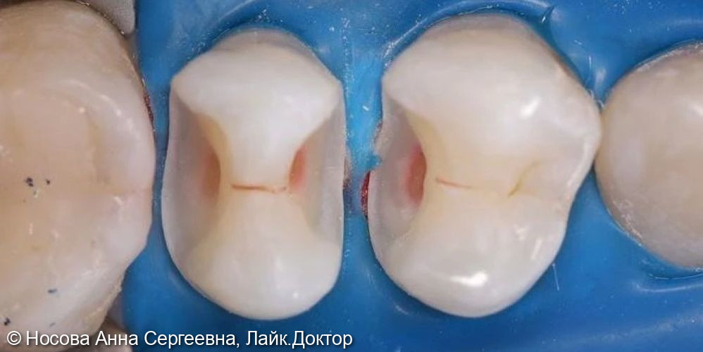 Лечение кариеса фото 3 · Вологда
