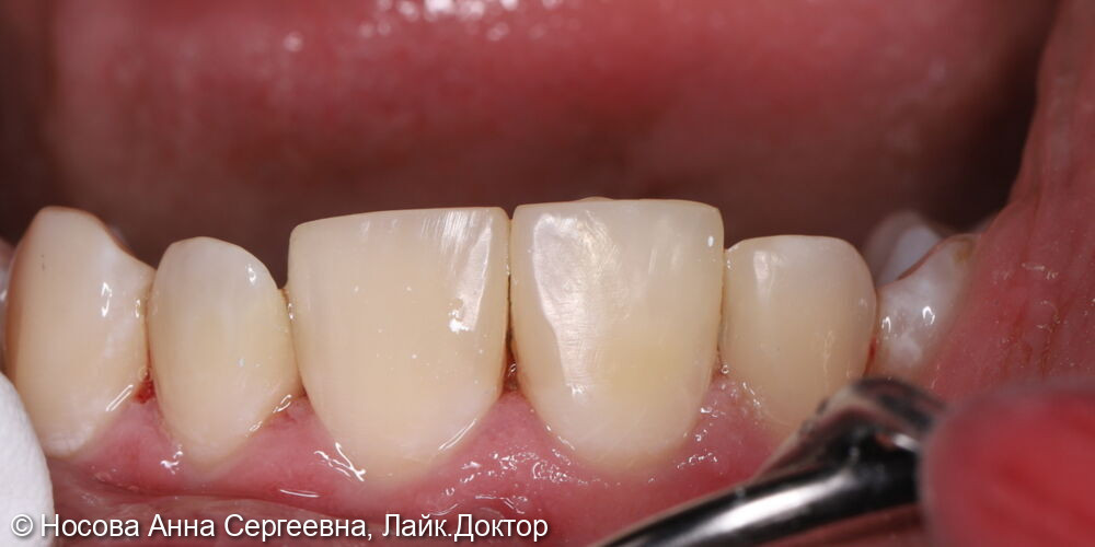 Лечение зубов 1.2, 1.1,2.1, 2.2 - фото №5