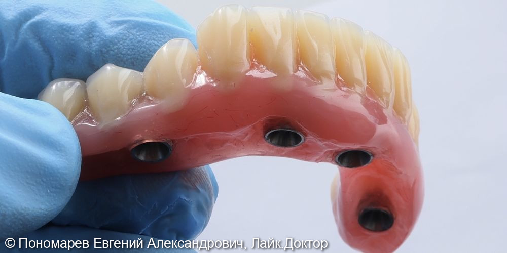 Зубы за один день, имплантация - фото №1