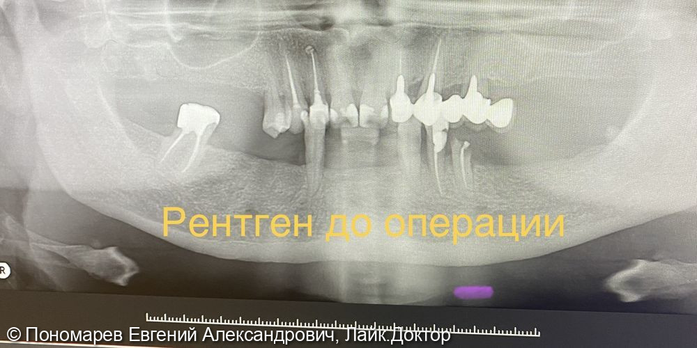 Зубы за один день, имплантация - фото №7