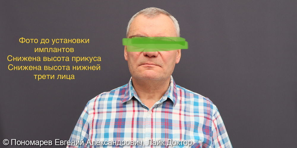 Имплантация все-на-6 двухчелюстная - после