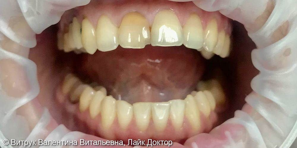 Восстановление зуба цельноциркониевой коронкой - фото №1
