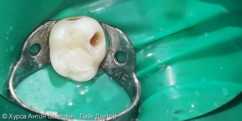 Лечение и реставрация зуба №75 фотополимером Ceram-X - фото №1