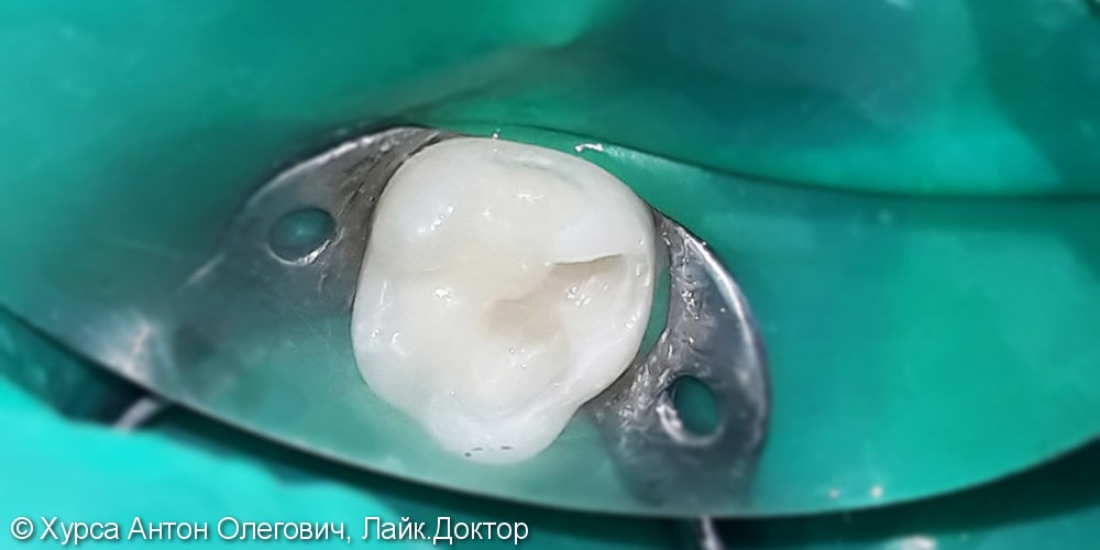 Лечение и реставрация зуба №75 фотополимером Ceram-X - фото №2