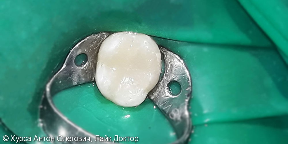 Лечение и реставрация зуба №75 фотополимером Ceram-X - фото №3