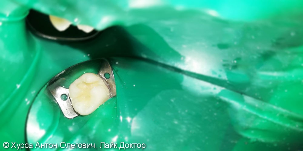 Лечение и реставрация зуба №16 фотополимером Ceram-X - фото №2