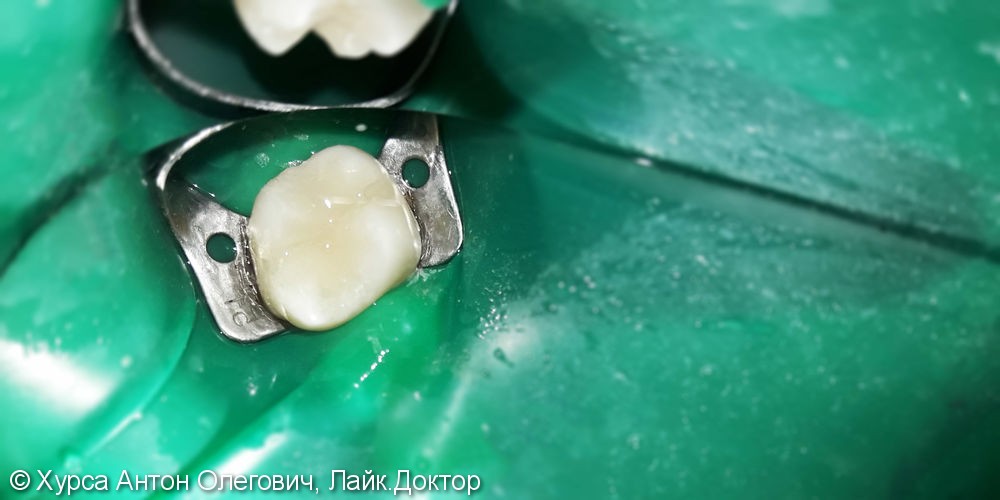 Лечение и реставрация зуба №16 фотополимером Ceram-X - фото №3