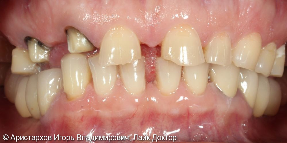 Пример протезирования коронками из оксида циркония зубов верхней челюсти - фото №1