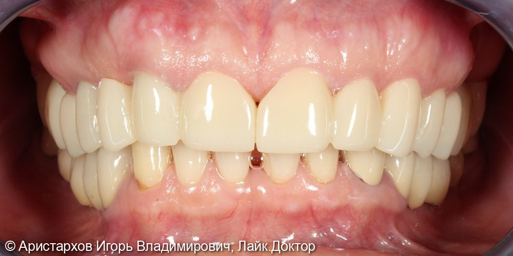 Пример протезирования коронками из оксида циркония зубов верхней челюсти - фото №8