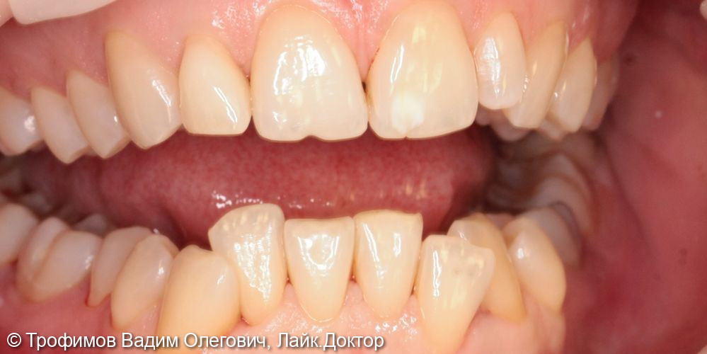 Снятие зубных отложений, пигментированного налета - фото №1