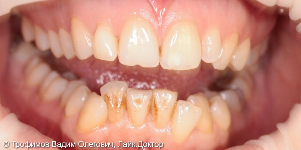 Снятие зубных отложений, пигментированного налета - фото №2