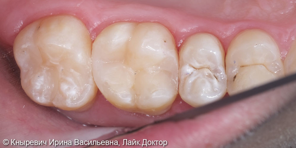 Лечение кариеса на 2х соседних жевательных зубах - фото №3