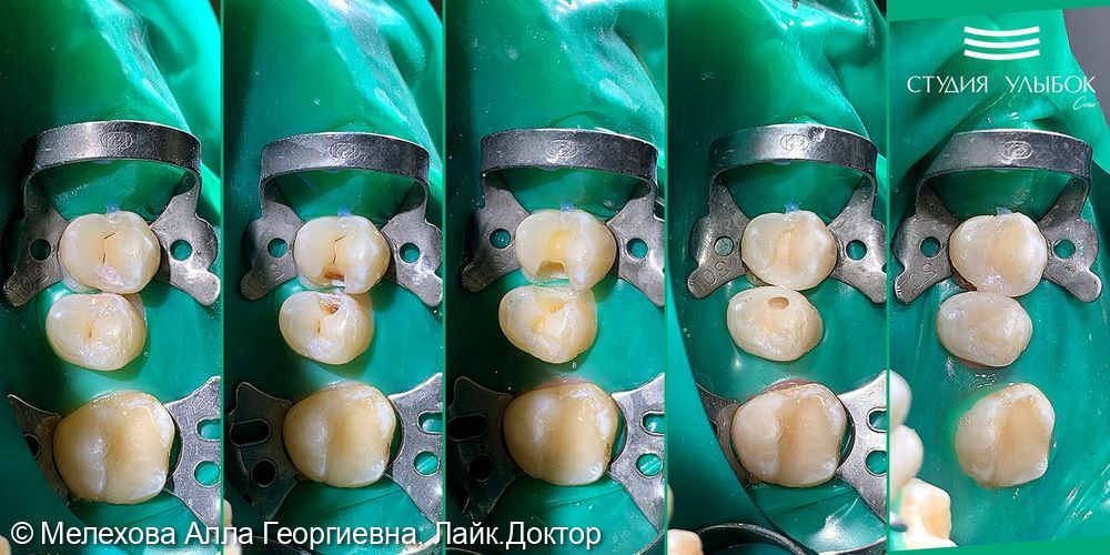 Лечение среднего кариеса 15 и 15 зубов - фото №1
