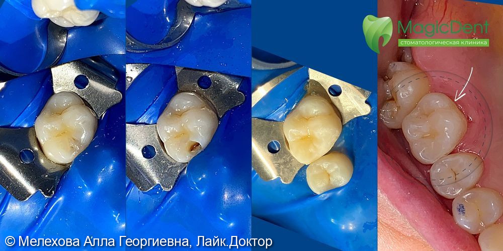 Кейс лечения скрытого кариеса средней глубины 26 зуба - фото №1