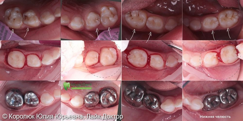 Клинический случай лечения сразу 8-ми зубов у ребенка 3,5 лет под наркозом - фото №1