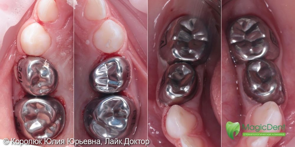 Клинический случай лечения сразу 8-ми зубов у ребенка 3,5 лет под наркозом - фото №2
