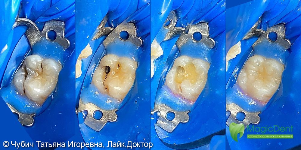 Клиническая ситуация лечения кариеса дентина седьмого зуба у подростка 14-ти лет - фото №1