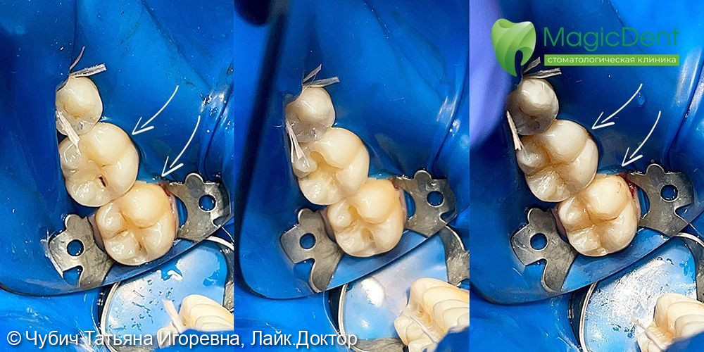 Лечение кариеса 36,37 зубов с восстановлением полной анатомии - фото №1