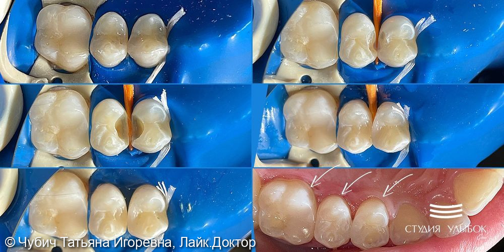 Лечение скрытого кариеса - фото №2