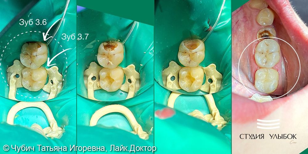 Лечение рецидива кариеса на 36,37 зубах - фото №1