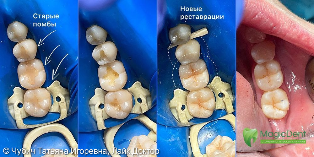 Плановая замена реставрации на зубах: 38, 37 - фото №1