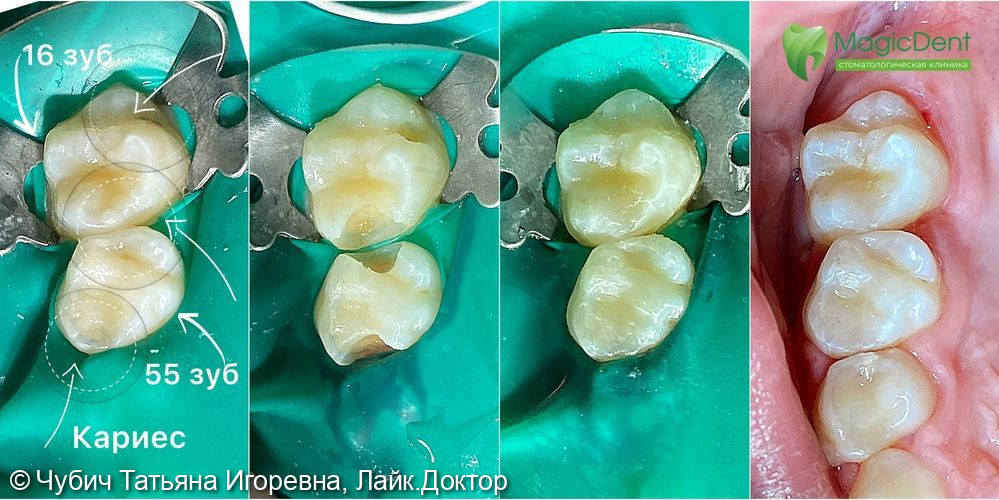 Лечение скрытого кариеса у ребенка (молочный зуб 55 и постоянный зуб 16) - фото №1