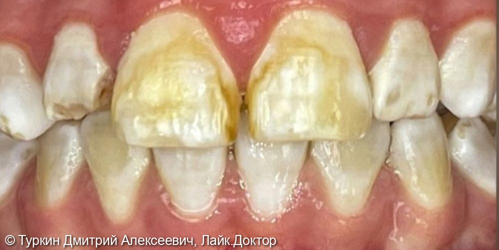 Эстетический дефект передних зубов - фото №1