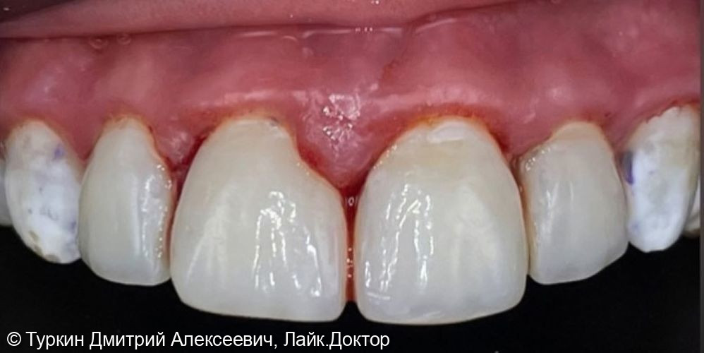 Эстетический дефект передних зубов - фото №2