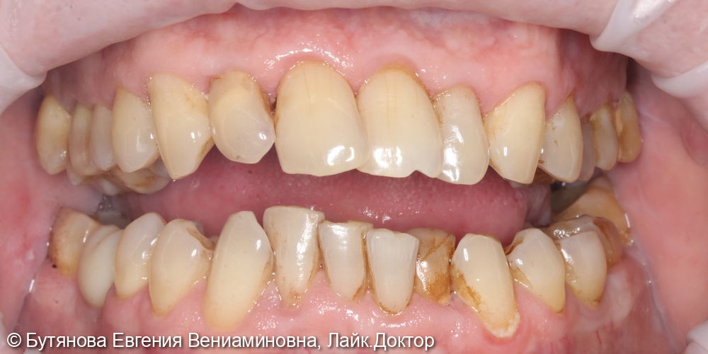 Профессиональная гигиена полости рта и зубов - фото №1