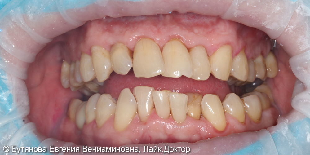 Профессиональная гигиена полости рта и зубов - фото №3