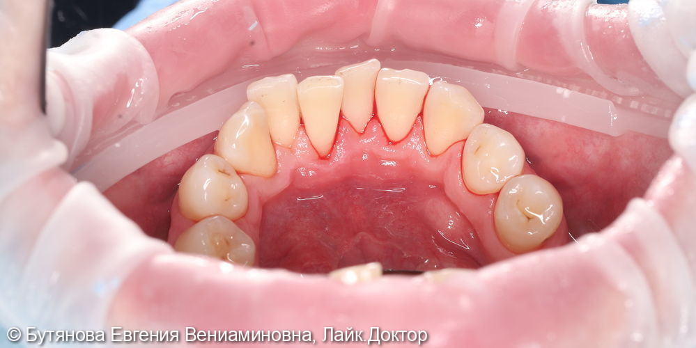 Профессиональная гигиена полости рта и зубов - фото №2