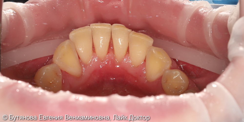 Профессиональная гигиена полости рта и зубов - фото №2