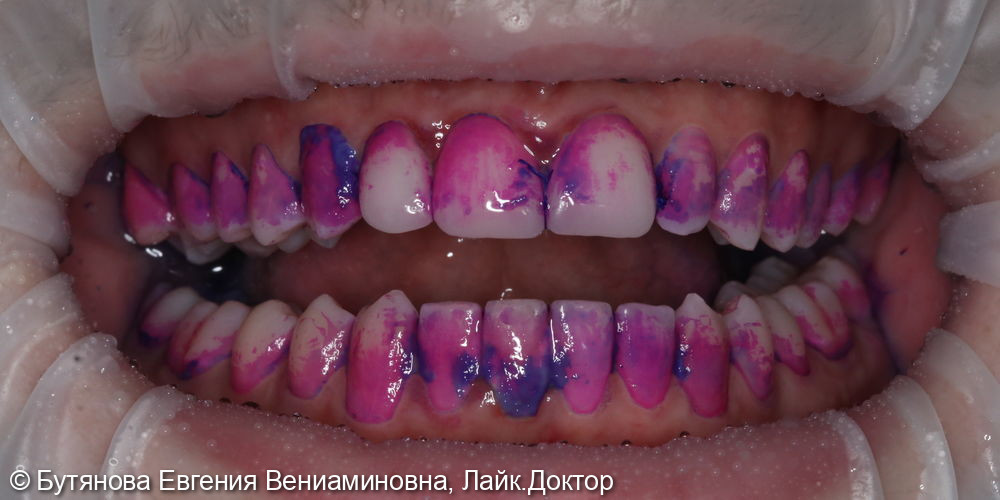 Профгигиена зубов фото 2 · Вологда