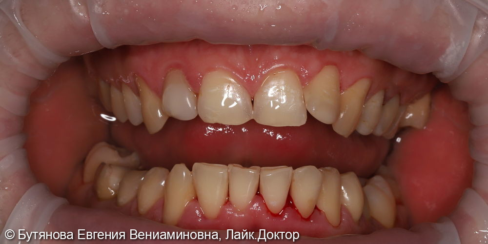 Профессиональная гигиена полости рта - фото №3