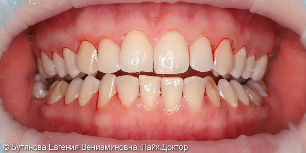 Профессиональная гигиена полости рта - фото №3