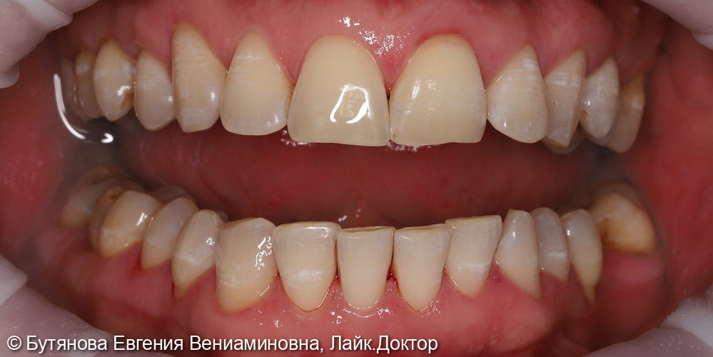Профессиональная гигиена полости рта - фото №3