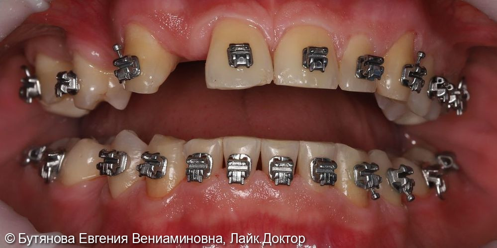Профгигиена при лечении на брекет-системе - фото №2