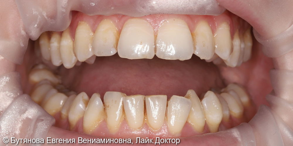 Профессиональная гигиена полости рта - фото №1