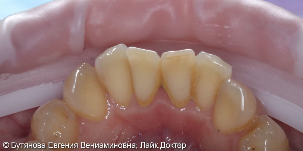 Профессиональная гигиена полости рта - фото №1