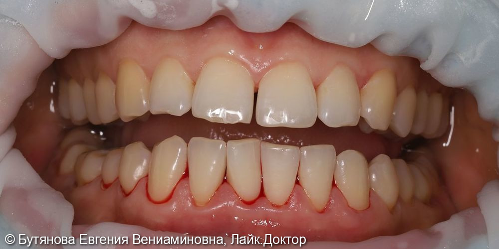 Профессиональная гигиена полости рта - фото №3