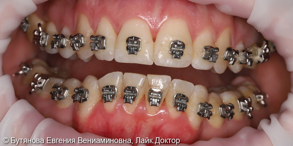 Профгигиена для пациента с брекет-системой - фото №1