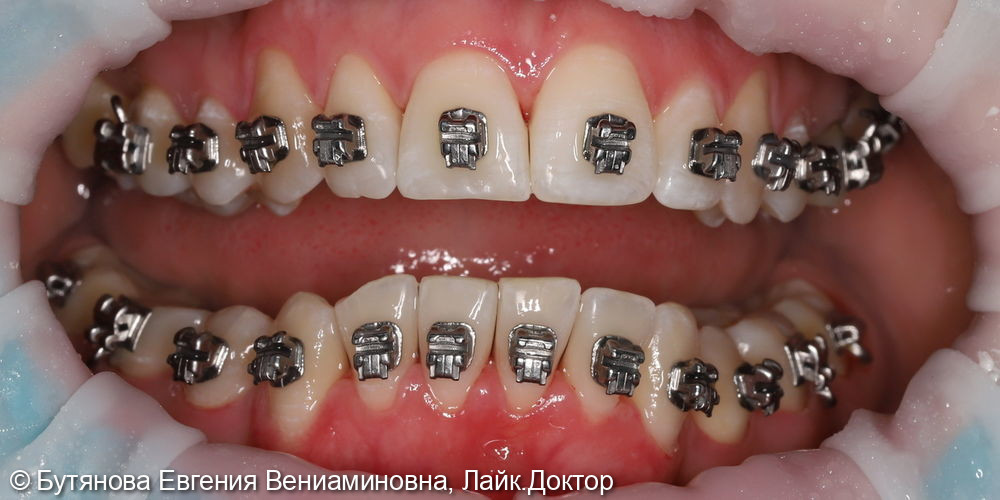 Профгигиена для пациента с брекет-системой - фото №3