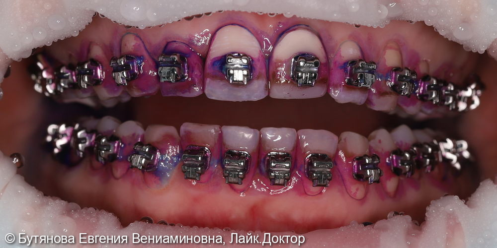 Профгигиена при ортодонтическом лечении фото 2 · Вологда