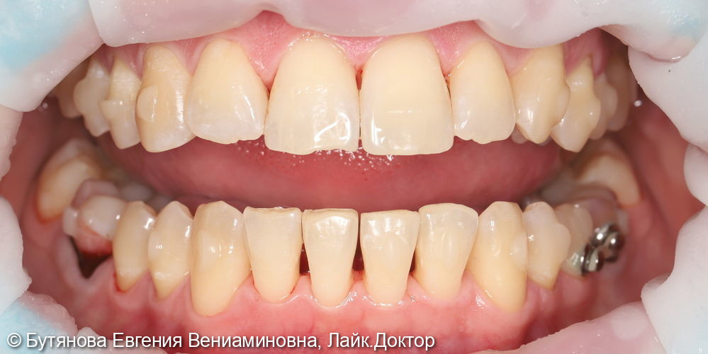 Профгигиена при ортодонтическом лечении на элайнерах - фото №9
