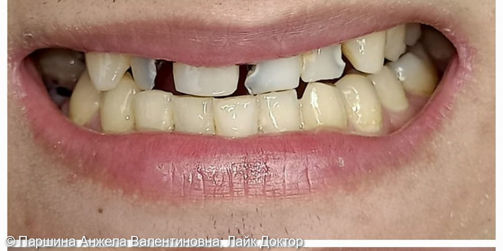 Реставрации фронтальных зубов - фото №1