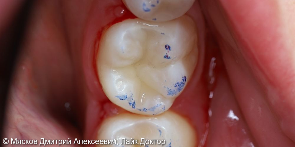 Лечение кариеса 3.5,3.7 зубов - фото №4