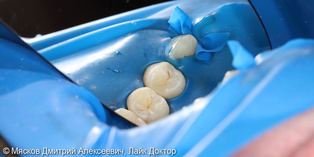 Лечение кариеса 2.4 зуба фото 3 · Ярославль